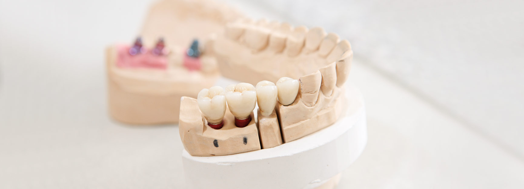 Implantologie in der Zahnarztpraxis in Aldenhoven