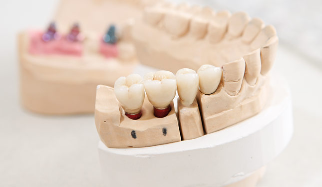 Zahnimplantat in der Zahnarztpraxis R. Schulte in Aldenhoven